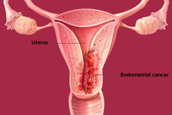 Endometrial Kanser
